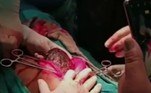 De acordo com o tabloide britânico Metro, o procedimento foi realizado em um hospital particular da cidade de Bokaro, na Índia
