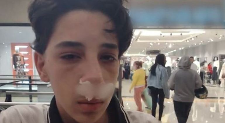 Joao Victor teve o nariz quebrado em duas partes após ser agredido por segurança de shopping