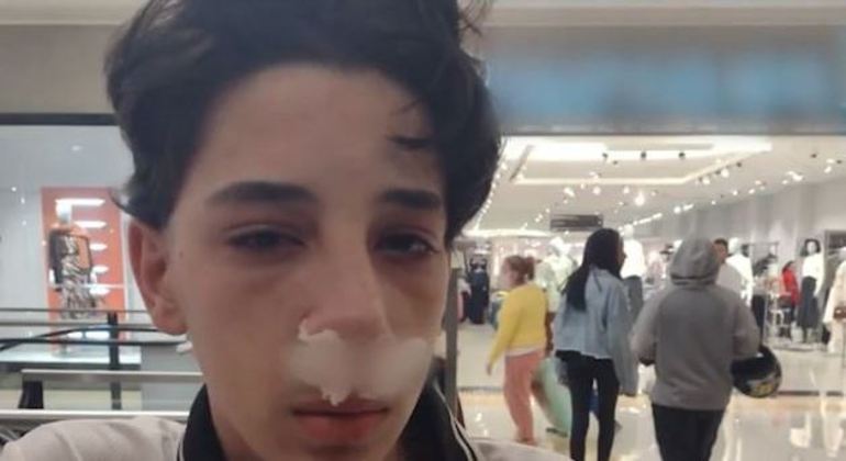 Adolescente terá de passar por cirurgia no nariz fraturado por causa da agressão