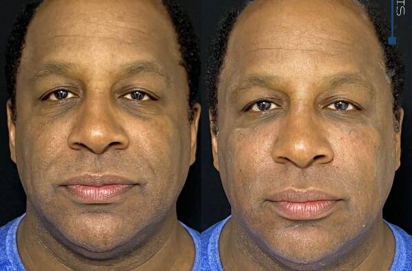 Ailton Graça antes e depois dos procedimentos estéticos no rosto