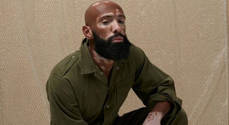 Akin Cavalcante se tornou referência em conscientização sobre vitiligo