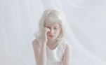 albinismo-pessoa albina