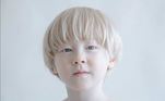 albinismo-pessoa albina