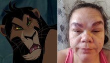 Alergia à tintura deixa mulher parecida com Scar, de 'O Rei Leão' 