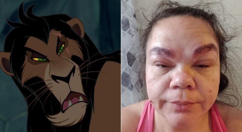 Alergia à tintura deixou mulher parecida com Scar, de 'O Rei Leão'