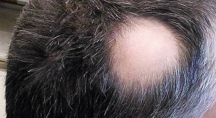 Alopecia areata causa perda de cabelo 