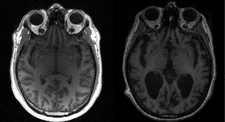 Ressonância magnética de um cérebro saudável (esquerda) e de um com Alzheimer (direita)
