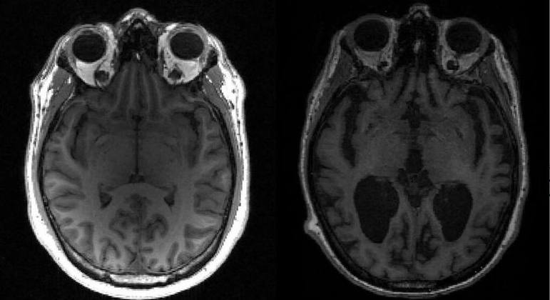 Ressonância magnética de um cérebro saudável (esquerda) e de um com Alzheimer (direita)
