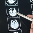 Chinês de 19 anos pode ser a pessoa mais jovem com Alzheimer (Freepik)
