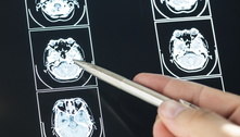 Pesquisadores encontram novo indicador que pode diagnosticar Alzheimer precocemente