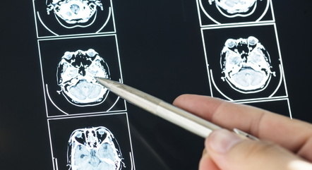 Células do hipocampo apresentam modificações no Alzheimer