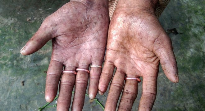 Dedos de Amal Sarker não têm padrões distintos encontrados na maioria das pessoas