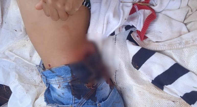 Indígena ferido em conflito com policiais
