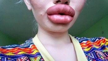 Estudante gasta mais de R$ 10 mil para ter os maiores lábios do mundo (Reprodução/Instagram)
