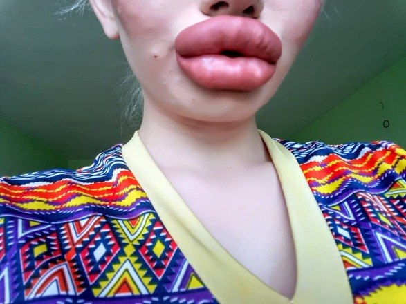 Uma estudante da Bulgária gastou nada menos que R$ 10 mil para realizar o sonho de ter os maiores lábios do mundo. Andrea Ivanova, de 22 anos, fez preenchimentos suficientes para triplicar o tamanho da boca, segundo ela, para ficar 'mais na moda'