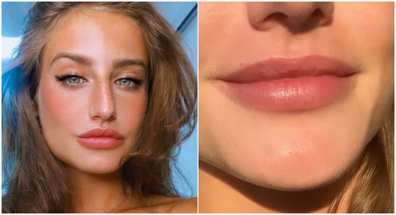 O antes e o depois da boca de Bruna Griphao