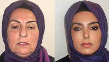 Antes e depois de cirurgia plástica em idosa de 68 anos gera polêmica (Reprodução/Instagram/@drmayaesthetic)