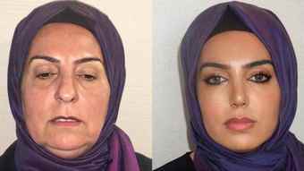 Before and after plastic surgery of a 68-year-old woman raises controversy: “I can’t believe it” – Viva a Vida