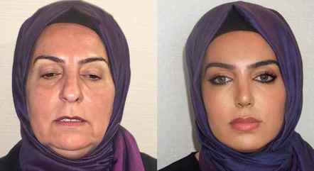 Antes e depois de procedimentos em idosa turca