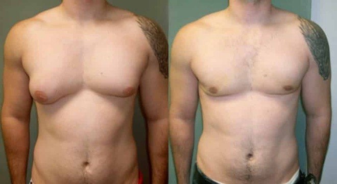 Antes e Depois Ginecomastia