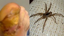 Durante piquenique, aranha pica e injeta ovos no dedão do pé de homem: 'Estavam me devorando'