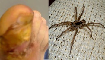 Aranha pica e injeta ovos no dedão do pé de homem: 'Me devorando' (Montagem/R7 (Reprodução/Colin Blake/ via NY Post e Bidgee/Wikimedia Commons))