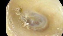 'Farfalhar incessante': aranha é sugada para fora do ouvido de paciente 