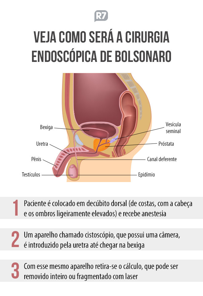 O passo a passo da cirurgia que será realizada por Bolsonaro