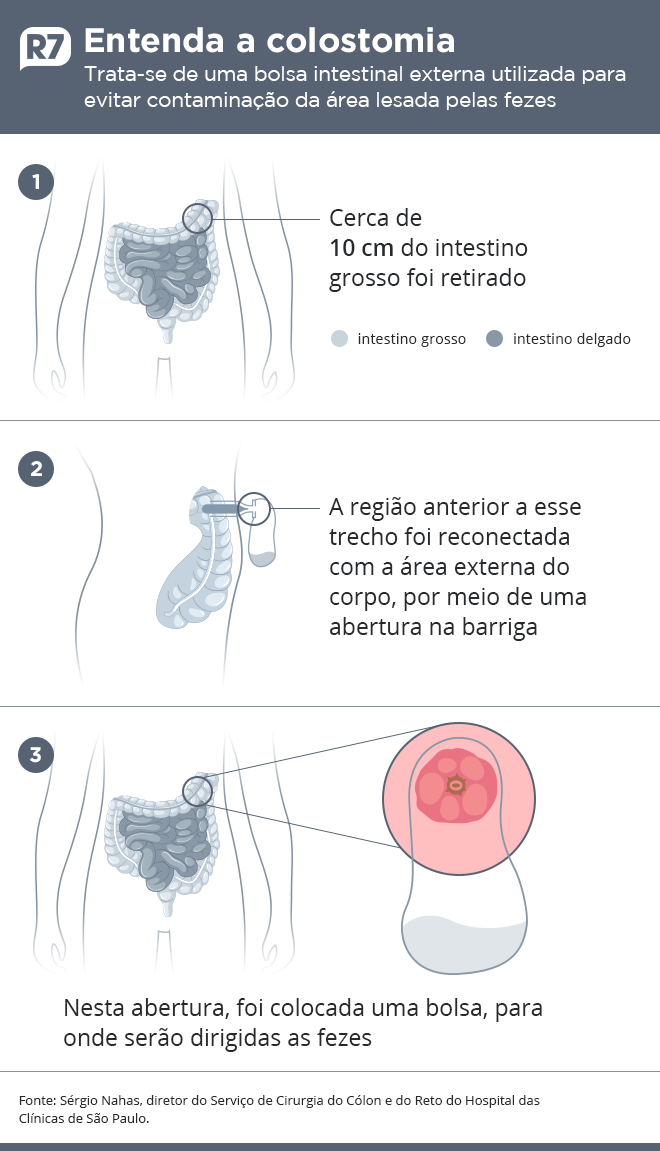 arte-colostomia