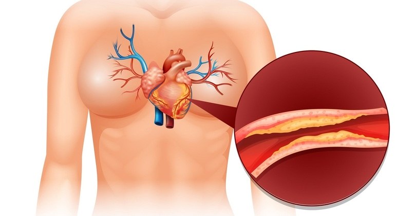 Placas de gordura dificultam a passagem de sangue para órgãos importantes
