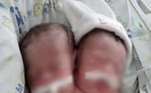 As bebês gêmeas siamesas que faleceram
