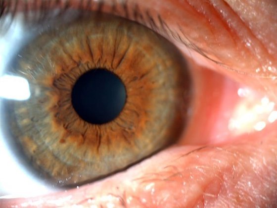 As causas mais comuns de visão dupla monocular são: opacidade do cristalino do olho, conhecido como catarata; problemas com o formato da córnea; e erro de refração não corrigido, em geral astigmatismo.