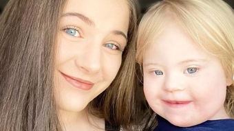 Algumas pessoas podem ter síndrome de Down sem sinais aparentes