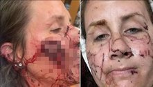 Ataque de lontra 'cruel e implacável' deixa mulher com ferimentos por todo o corpo