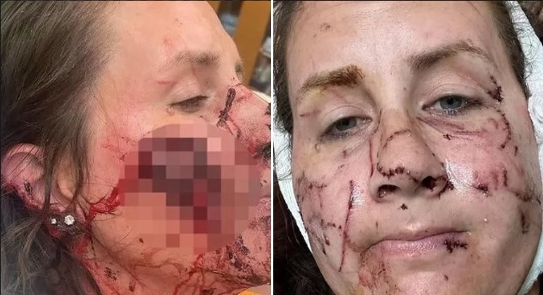 Mulher atacado por lontra nso EUA teve ferimentos por todo o corpo