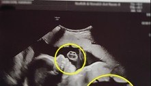 Futura mãe se assusta ao ver Baby da Silva Sauro em ultrassom