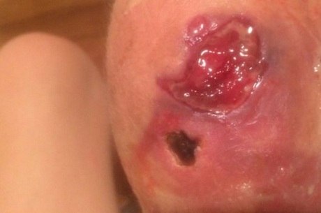 Difícil de tratar e com tempo de recuperação entre seis e 12 meses, úlcera tem levado muitos pacientes a fazerem cirurgia reconstrutiva 