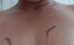 Dois meses após descobrir a violência que sua filha passou, Ana sofreu uma tentativa de homicídio. 'Eram dois homens... Eles me levaram para o meio do mato, me amarraram, me cortaram e me estupraram', relatou a mulher. Depois do ocorrido, a Justiça entendeu que ela precisava ir imediatamente para um abrigo