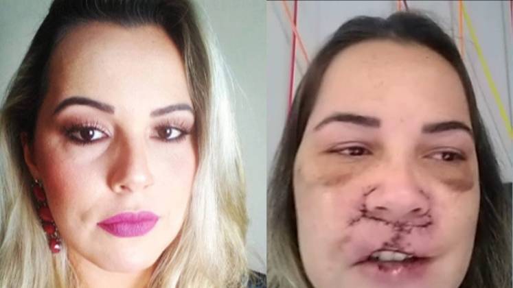 O Balanço Geral Manhã mostrou como a busca pelo corpo perfeito pode trazer sérios prejuízos. A influenciadora digital Mariana Michelini ficou com o rosto deformado e várias sequelas, após passar por um procedimento estético. Agora, ela luta para conseguir reconstruir as áreas afetadas e voltar a ter uma vida normal