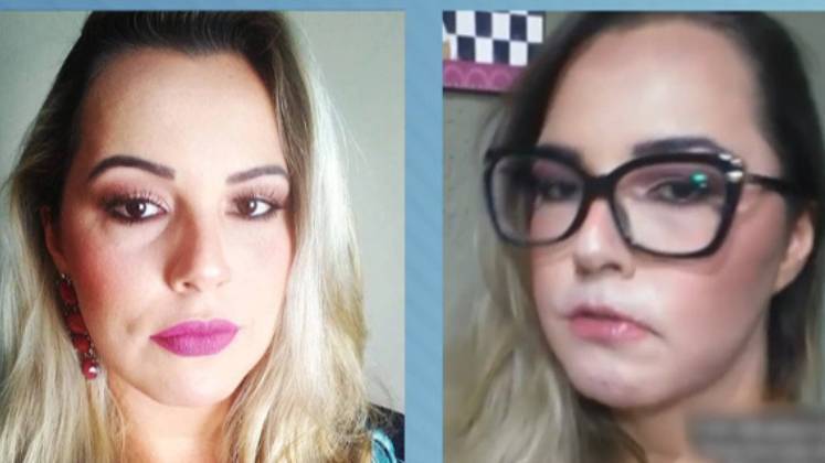 O produto causou uma reação grave e a influenciadora teve que recorrer a um cirurgião plástico para fazer a remoção. 