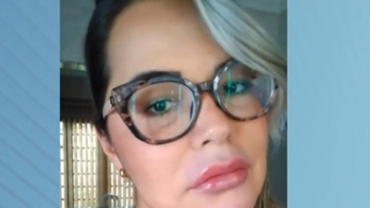 Mariana conta que acreditou ter injetado ácido hialurônico na face e na boca. Porém, descobriu seis meses depois que a profissional aplicou uma mistura de silicone e PMMA, o polimetilmetacrilato, que é um material que preenche volumes do tecido