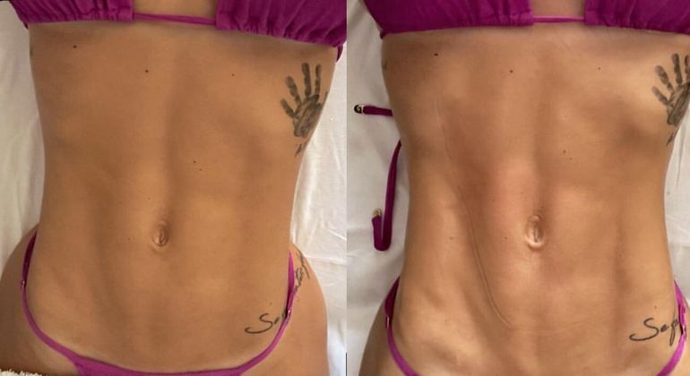 A barriga de Virginia antes (à esquerda) e depois da massagem modeladora