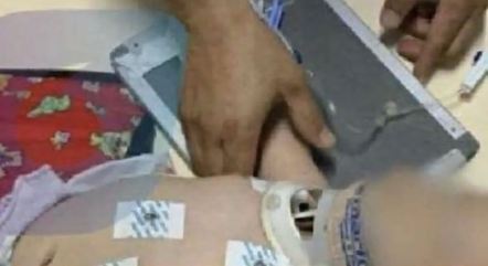 Bebê tem cerca de 30 lesões aparentes no corpo