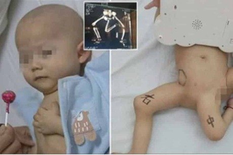 bebê cirurgia terceira perna