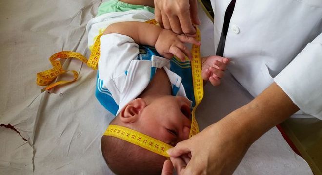 BebÃªs com microcefalia apresentam crÃ¢nio menor que 33 cm