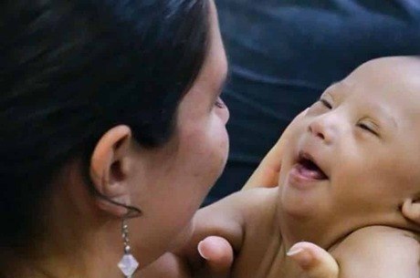 bebê com Síndrome de Down