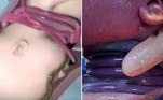 Um bebê chinês sobreviveu e nasceu com o cordão umbilical enrolado seis vezes em torno do pescoço