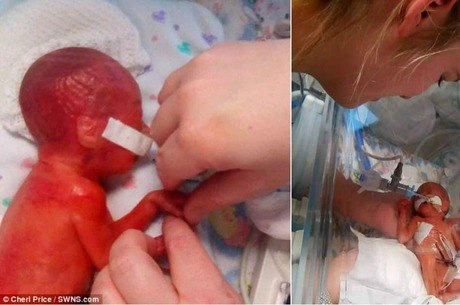 bebe extremamente prematuro