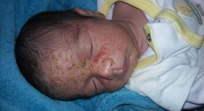 bebe herpes mae alerta