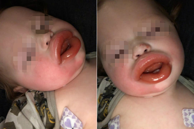 Indigesto Bebe Fica Com Labios Inflados Apos Mastigar Centopeia Fotos R7 Hora 7